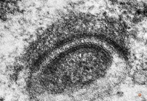 M,12y. | germinoma - intracellular desmosom M,12y. | germinoma - intracellular desmosom